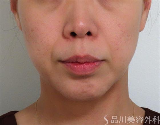 症例NO.36745のBEFORE写真