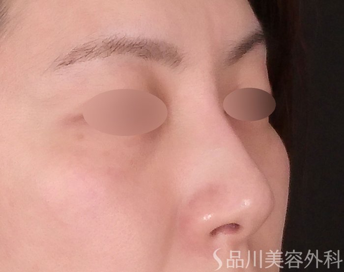 症例NO.70471のBEFORE写真