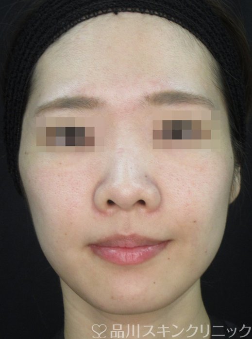 症例NO.72243のAFTER写真