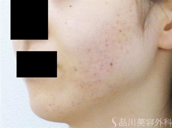 症例NO.24284のAFTER写真
