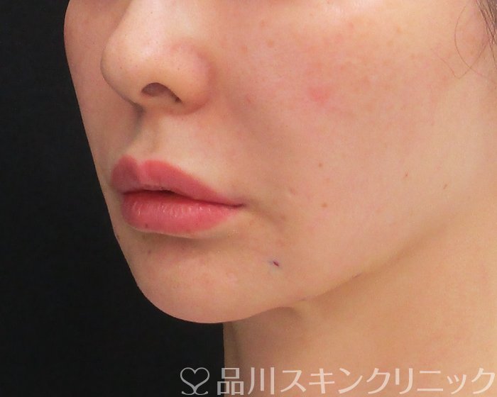 症例NO.75266のAFTER写真