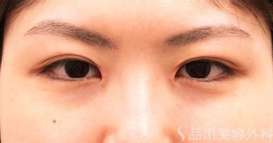 症例NO.57818のAFTER写真