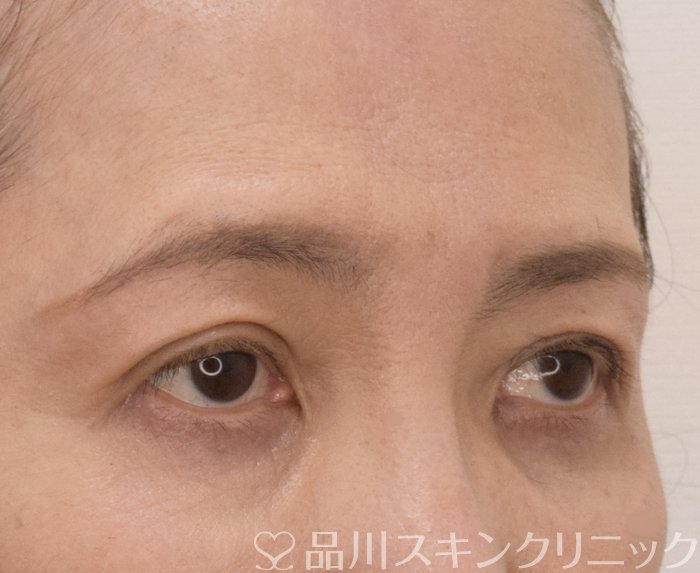 症例NO.71384のAFTER写真