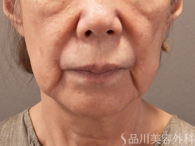 症例NO.73193のBEFORE写真