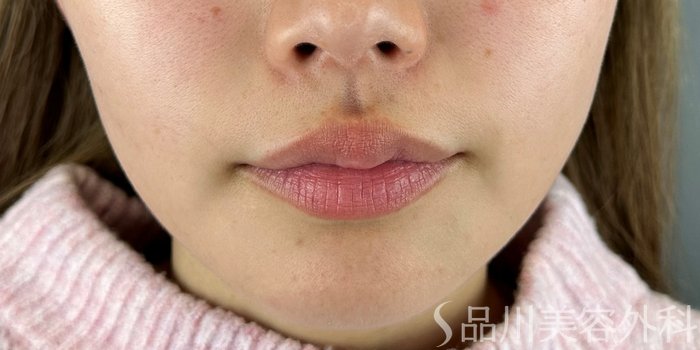 症例NO.70179のBEFORE写真