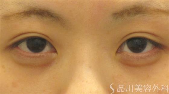 症例NO.41633のAFTER写真