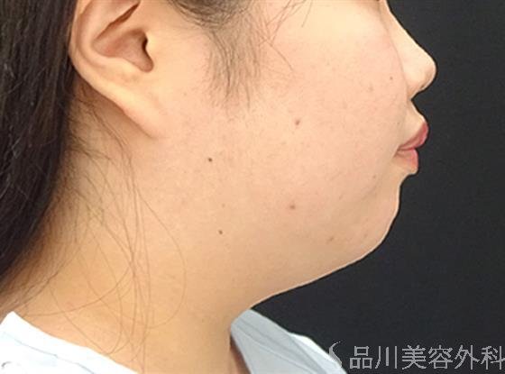 症例NO.40591のBEFORE写真