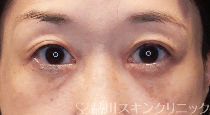 症例NO.69557のAFTER写真