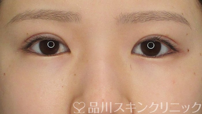 症例NO.73867のAFTER写真
