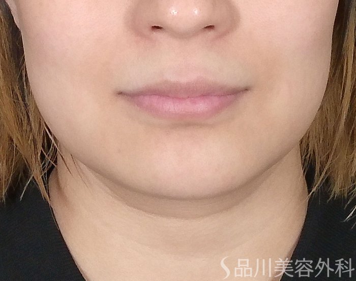 症例NO.64748のBEFORE写真