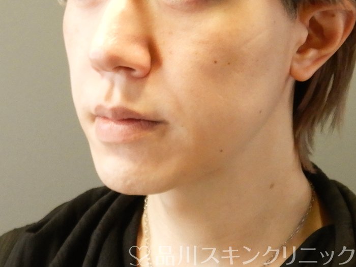 症例NO.63366のAFTER写真