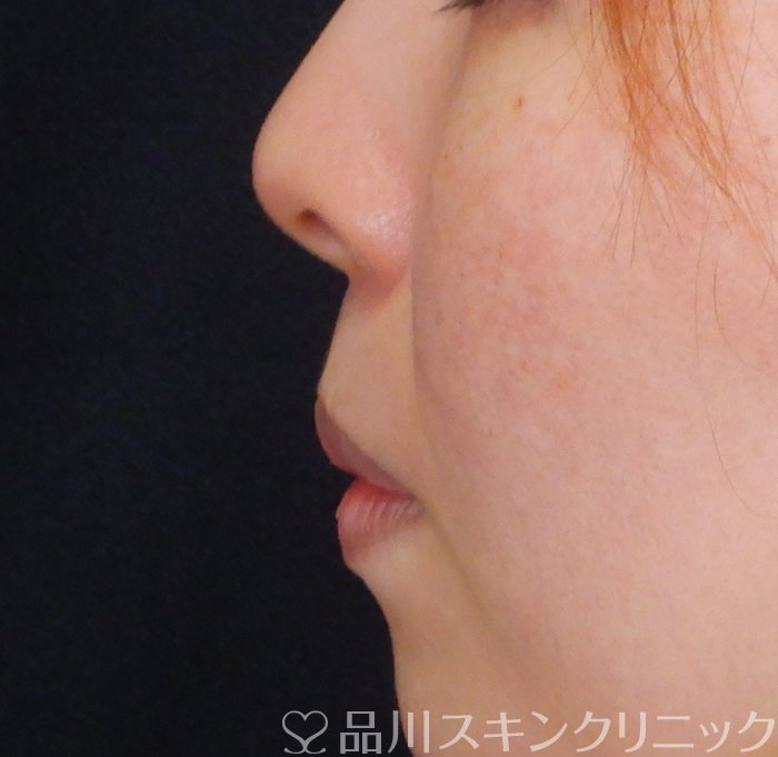 症例NO.66085のBEFORE写真