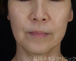 症例NO.71020のBEFORE写真