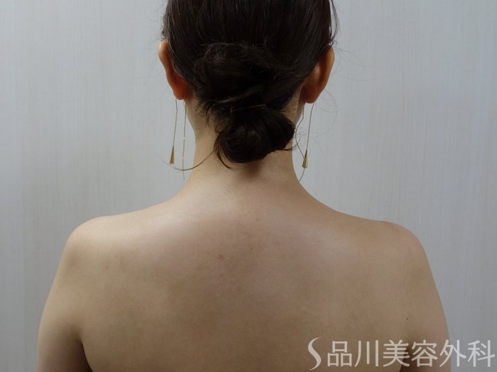 症例NO.73378のAFTER写真