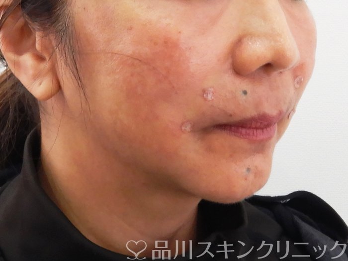 症例NO.62186のAFTER写真