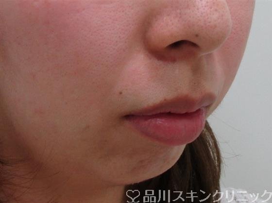 症例NO.34789のBEFORE写真