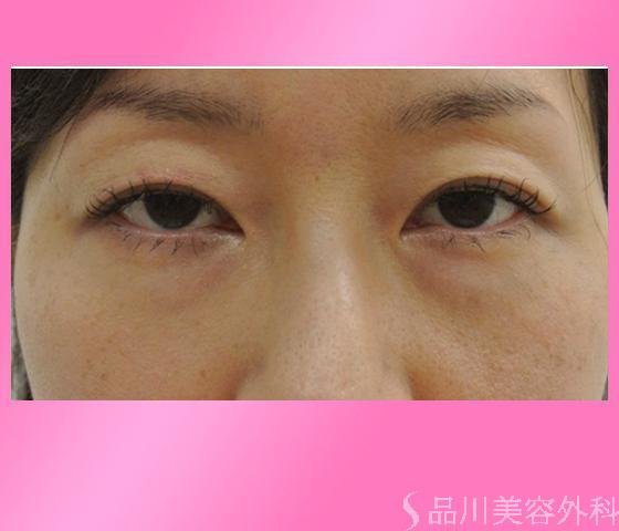 症例NO.14481のAFTER写真