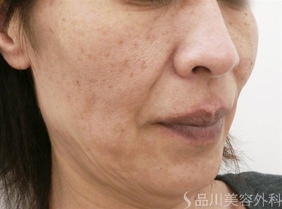 症例NO.25629のBEFORE写真