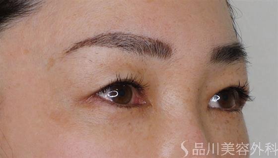 症例NO.51223のBEFORE写真
