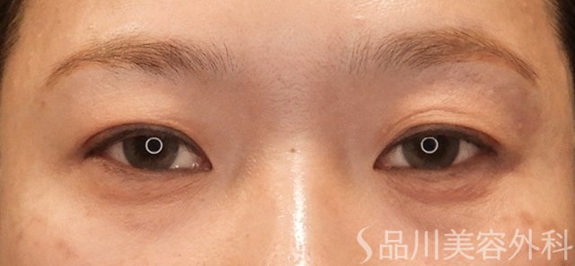 症例NO.72767のBEFORE写真