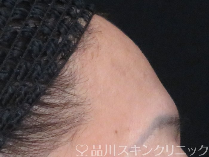 症例NO.69512のBEFORE写真