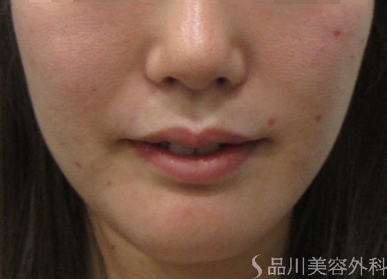 症例NO.20223のAFTER写真