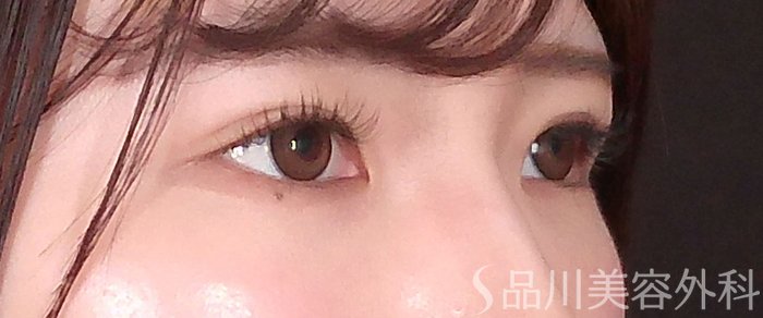 症例NO.70104のAFTER写真