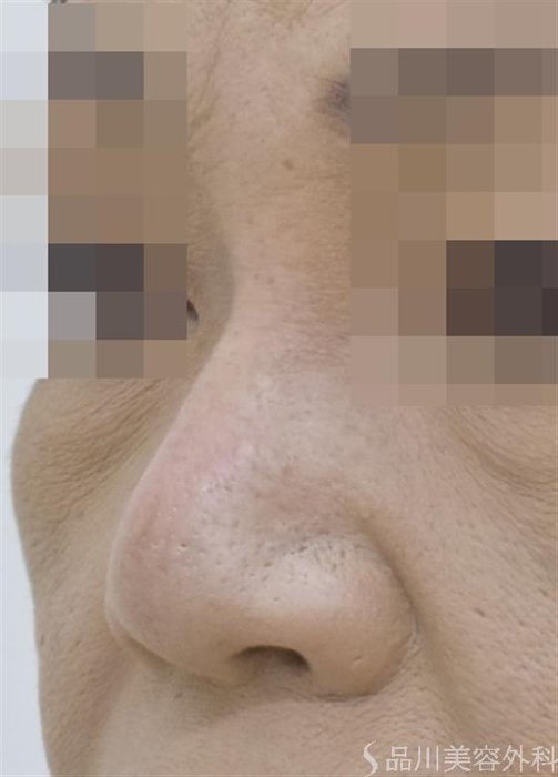 症例NO.51563のAFTER写真