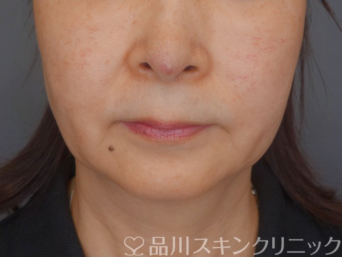 症例NO.72260のBEFORE写真