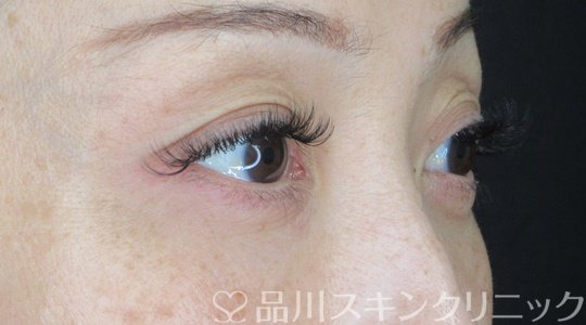症例NO.69633のAFTER写真