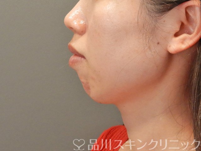 症例NO.75063のBEFORE写真