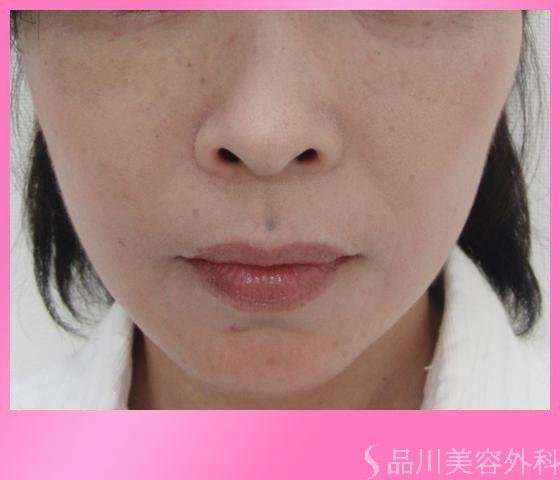 症例NO.4053のAFTER写真