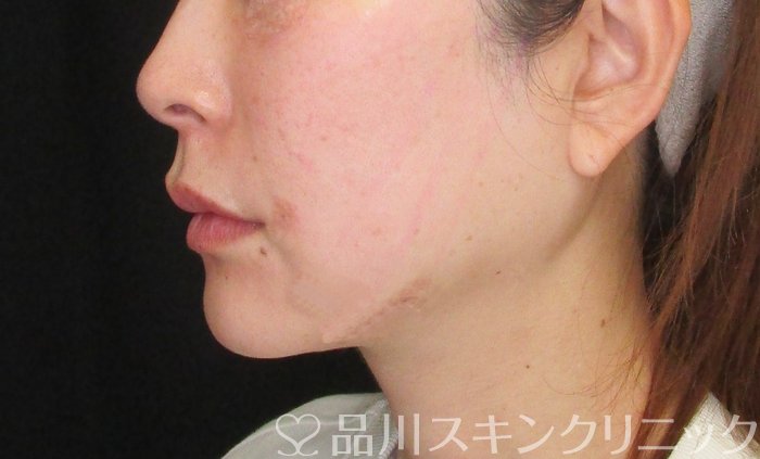 症例NO.74265のAFTER写真