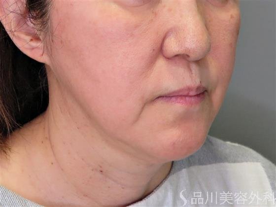 症例NO.48568のBEFORE写真