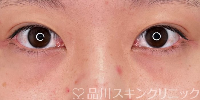 症例NO.69879のBEFORE写真