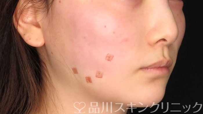 症例NO.71092のAFTER写真