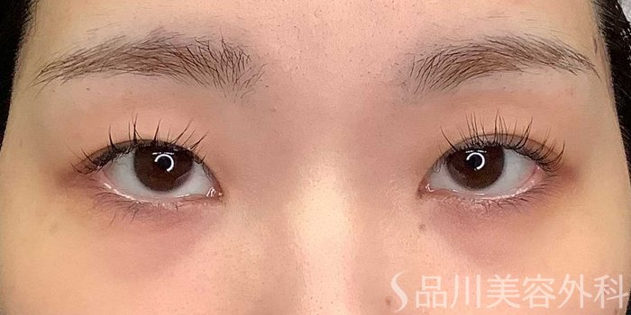 症例NO.69704のBEFORE写真