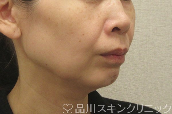 症例NO.74830のBEFORE写真