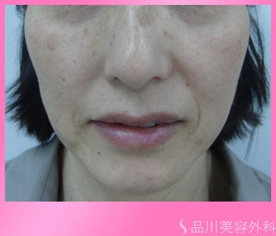 症例NO.2852のBEFORE写真