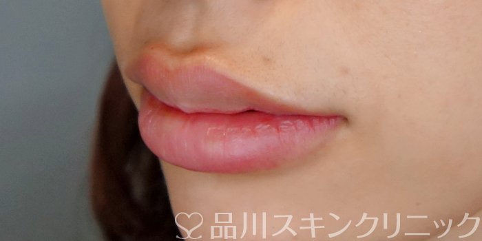 症例NO.70899のAFTER写真