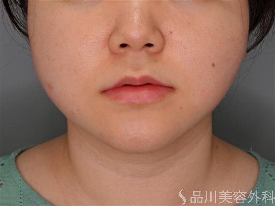 症例NO.55083のAFTER写真