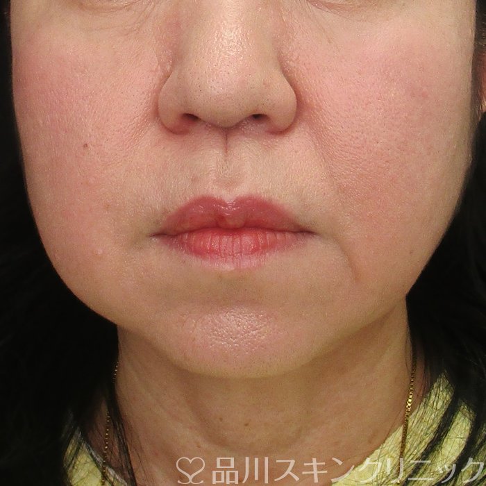 症例NO.72781のBEFORE写真