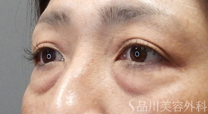 症例NO.70095のBEFORE写真