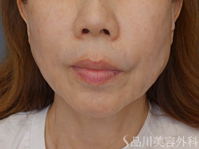 症例NO.71619のBEFORE写真