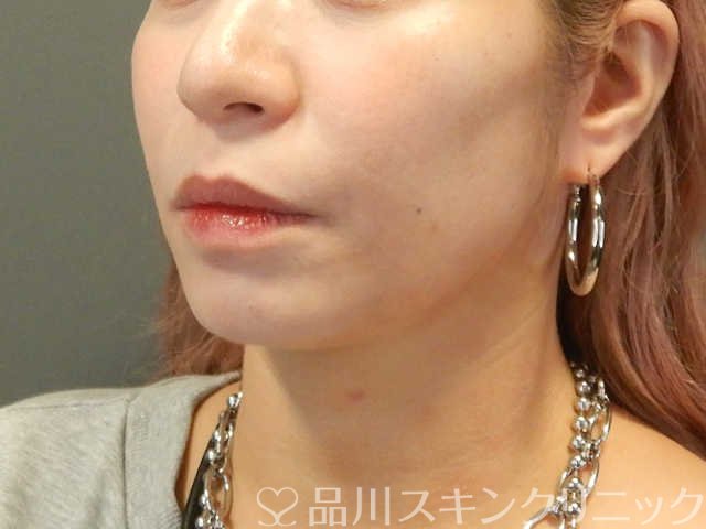症例NO.66860のBEFORE写真