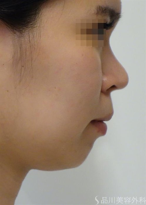 症例NO.36421のBEFORE写真