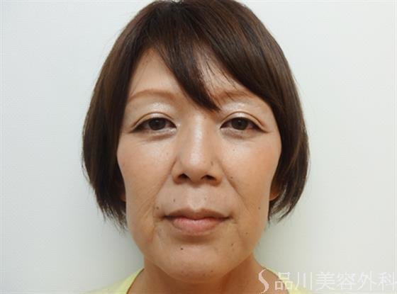 症例NO.26665のBEFORE写真