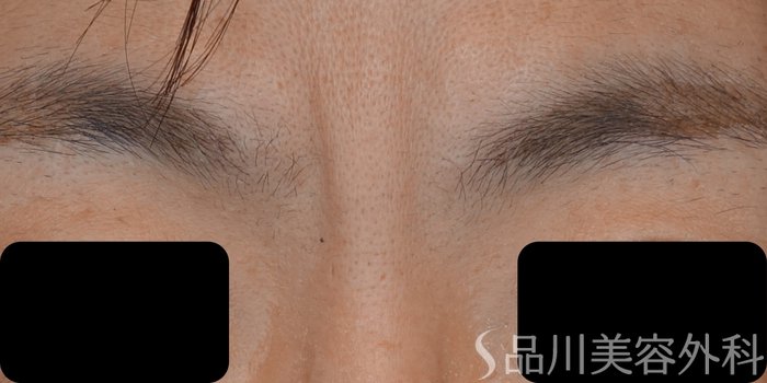 症例NO.72169のBEFORE写真