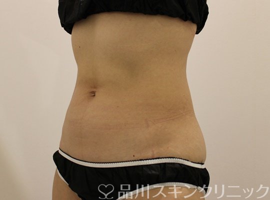 症例NO.71103のAFTER写真