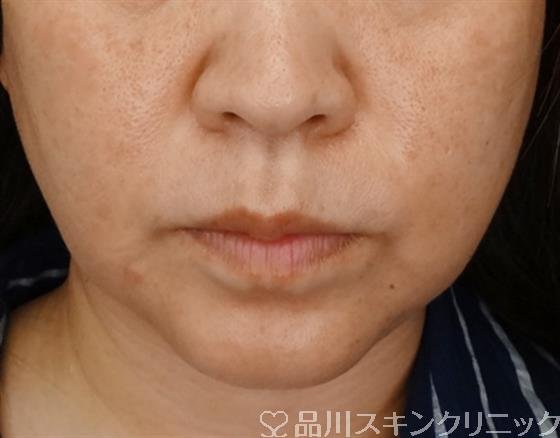 症例NO.48361のBEFORE写真